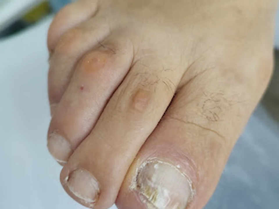 Italita melo podologia medical.Especialista em calos , fissuras calcâneo ,unhas encravadas e reflexologia podal., Lisboa